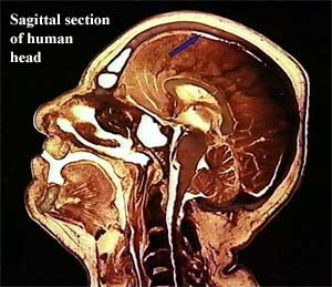 Sagittal section